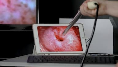 Camera and AI for Early Detection of Cervical Cancer
